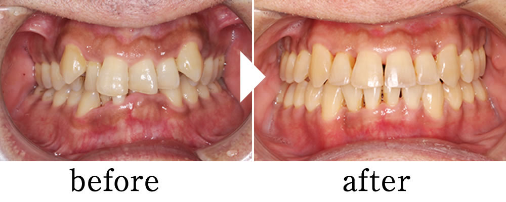 マウスピース矯正治療の症例